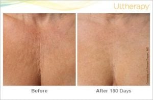 ultherapy: beforeandafter-180day_1tx_chest